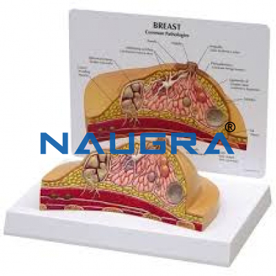 Breast Cancer Model