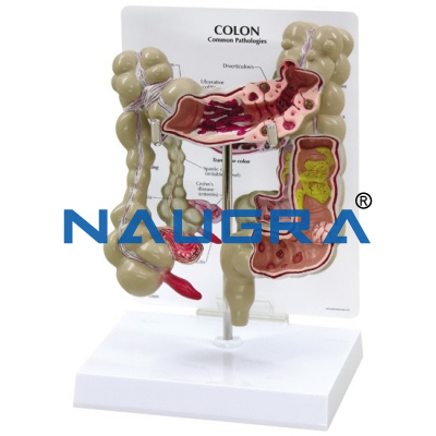 Colon Model With Pathologies