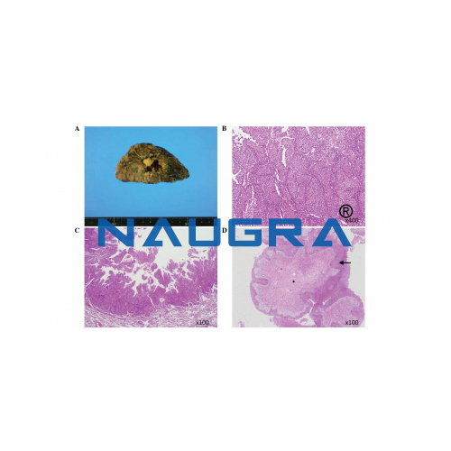 Biology Lab Lung Abscess Complicated by Fungus Ball Model