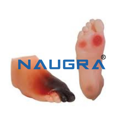 Diabetic Foot Model